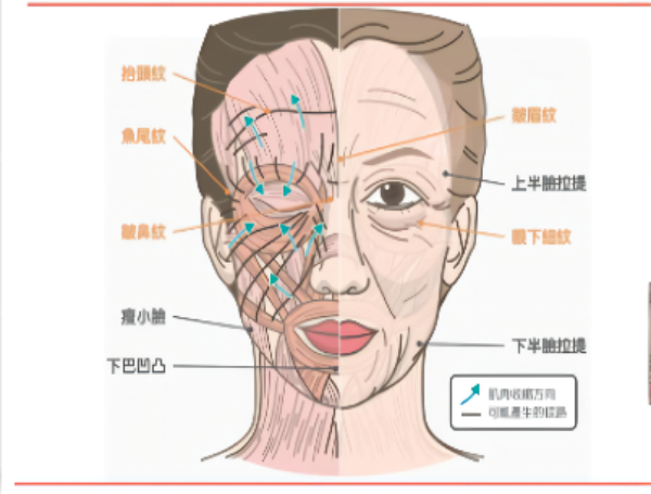肉毒素是什么？在医疗美容行业的应用介绍